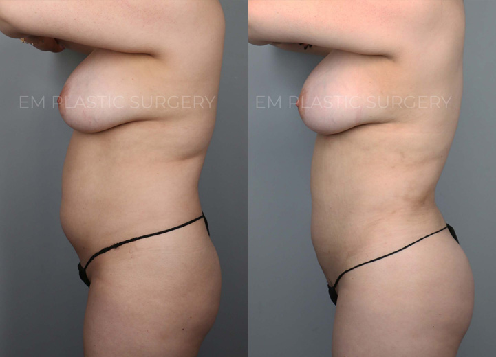 Brazilian Butt Lift Before & After Photo Gallery