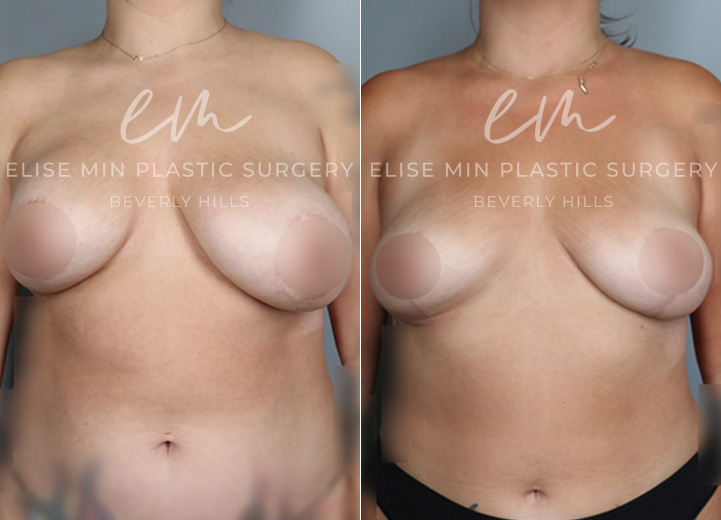 During puberty, this 39-year-old woman developed asymmetrical breasts where her left breast was significantly larger than her right breast. A condition like this is called a hypoplastic breast, which simply describes a breast that did not fully grow. Additionally, she had some tuberous breast characteristics, with very large nipple areolar complexes and a short distance between her nipple and her high-sitting breast fold. As a teenager, she underwent a saline implant augmentation on the right and a breast lift on the left. However, it still left her with significant asymmetry, and she felt self-conscious about her breasts for the subsequent twenty years. During this time, the implant side also developed a thick capsule, known as capsular contracture. Having had a complex relationship with her very own breasts during her lifetime, she wanted symmetry and was no longer interested in implants. On her right breast, her implants and thick capsule were removed, and her own fat was injected into the side to increase the volume. The larger left side had a significant reduction procedure performed to match the right. Both sides had a necessary lift to make the nipple areolar complex more symmetrical in shape and location. After the procedure, she couldn’t believe that she now had breasts that were symmetrical, which was a huge and happy paradigm shift for her.