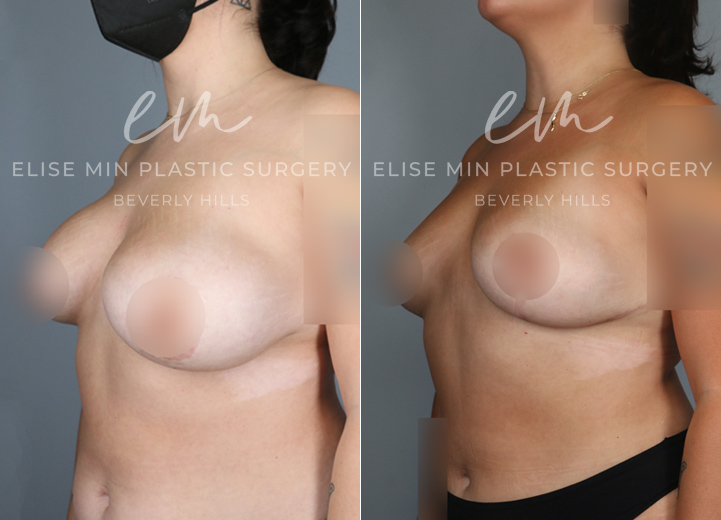 During puberty, this 39-year-old woman developed asymmetrical breasts where her left breast was significantly larger than her right breast. A condition like this is called a hypoplastic breast, which simply describes a breast that did not fully grow. Additionally, she had some tuberous breast characteristics, with very large nipple areolar complexes and a short distance between her nipple and her high-sitting breast fold. As a teenager, she underwent a saline implant augmentation on the right and a breast lift on the left. However, it still left her with significant asymmetry, and she felt self-conscious about her breasts for the subsequent twenty years. During this time, the implant side also developed a thick capsule, known as capsular contracture. Having had a complex relationship with her very own breasts during her lifetime, she wanted symmetry and was no longer interested in implants. On her right breast, her implants and thick capsule were removed, and her own fat was injected into the side to increase the volume. The larger left side had a significant reduction procedure performed to match the right. Both sides had a necessary lift to make the nipple areolar complex more symmetrical in shape and location. After the procedure, she couldn’t believe that she now had breasts that were symmetrical, which was a huge and happy paradigm shift for her.