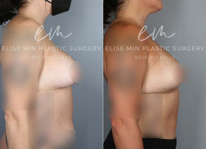 During puberty, this 39-year-old woman developed asymmetrical breasts where her left breast was significantly larger than her right breast. A condition like this is called a hypoplastic breast, which simply describes a breast that did not fully grow. Additionally, she had some tuberous breast characteristics, with very large nipple areolar complexes and a short distance between her nipple and her high-sitting breast fold. As a teenager, she underwent a saline implant augmentation on the right and a breast lift on the left. However, it still left her with significant asymmetry, and she felt self-conscious about her breasts for the subsequent twenty years. During this time, the implant side also developed a thick capsule, known as capsular contracture. Having had a complex relationship with her very own breasts during her lifetime, she wanted symmetry and was no longer interested in implants. On her right breast, her implants and thick capsule were removed, and her own fat was injected into the side to increase the volume. The larger left side had a significant reduction procedure performed to match the right. Both sides had a necessary lift to make the nipple areolar complex more symmetrical in shape and location. After the procedure, she couldn’t believe that she now had breasts that were symmetrical, which was a huge and happy paradigm shift for her.