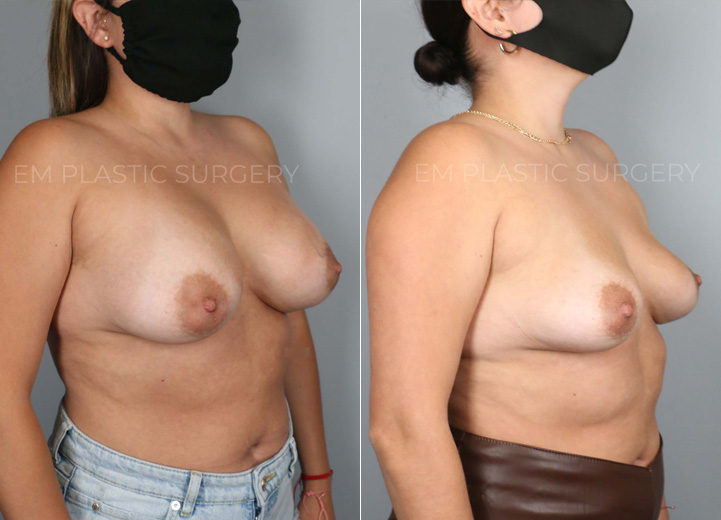 This is a 28 year-old patient who wanted her implants removed. She no longer cared for them
and felt that the implants were contributing to more back pain for her. The patient also wanted
to start trying to get pregnant so she wanted to get the surgery out of the way. She was initially
interested in a breast lift and fat transfer at the time of the removal but after my discussion
with her, she decided to see how she would bounce back with the implant removal alone. After
all, she had very youthful skin and tissue and had never undergone pregnancy and
breastfeeding so there was a good chance that her breasts would restore their shape without
additional procedures. She had 375cc breast implants removed in the operating room and her
breasts bounced back to looking natural and beautiful. She was so happy that she didn’t have to
undergo additional lift and fat transfer to achieve the outcome that she did.