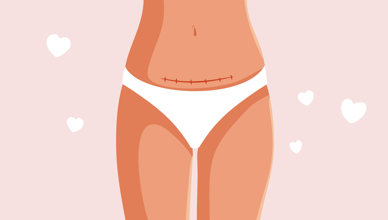 Featured image for Tips for Minimizing Tummy Tuck Scarring